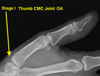 OSTEOARTHRITIS CARPOMETACARPAL CMC JOINT OF THUMB Hand Surgery Resource